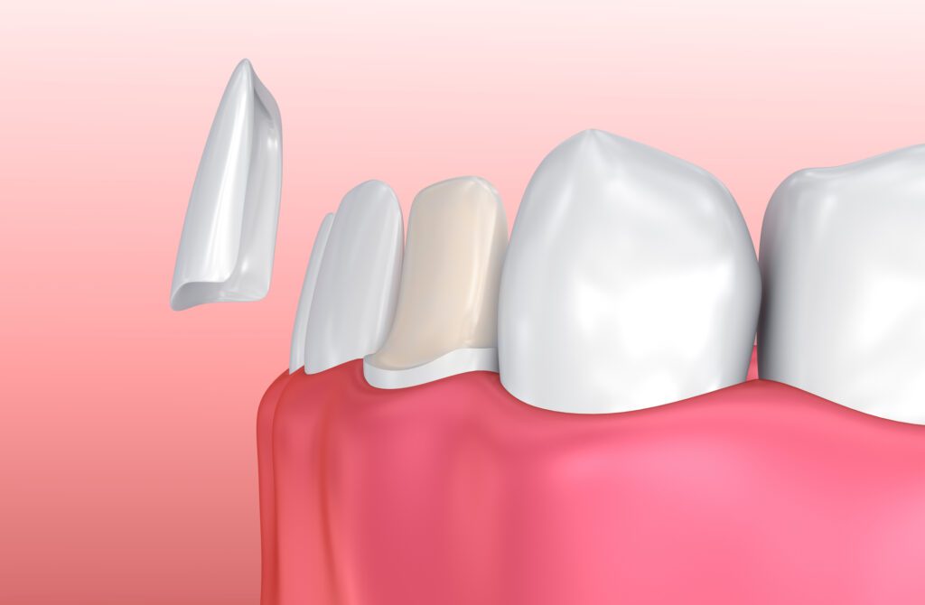 PORCELAIN VENEERS in WAYNE PA could help fix a variety of minor issues with your smile