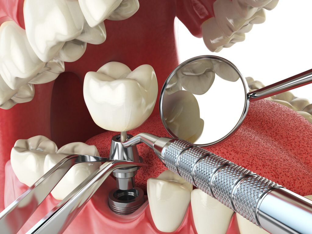DENTAL IMPLANTS in WAYNE PA could help restore your bite and smile