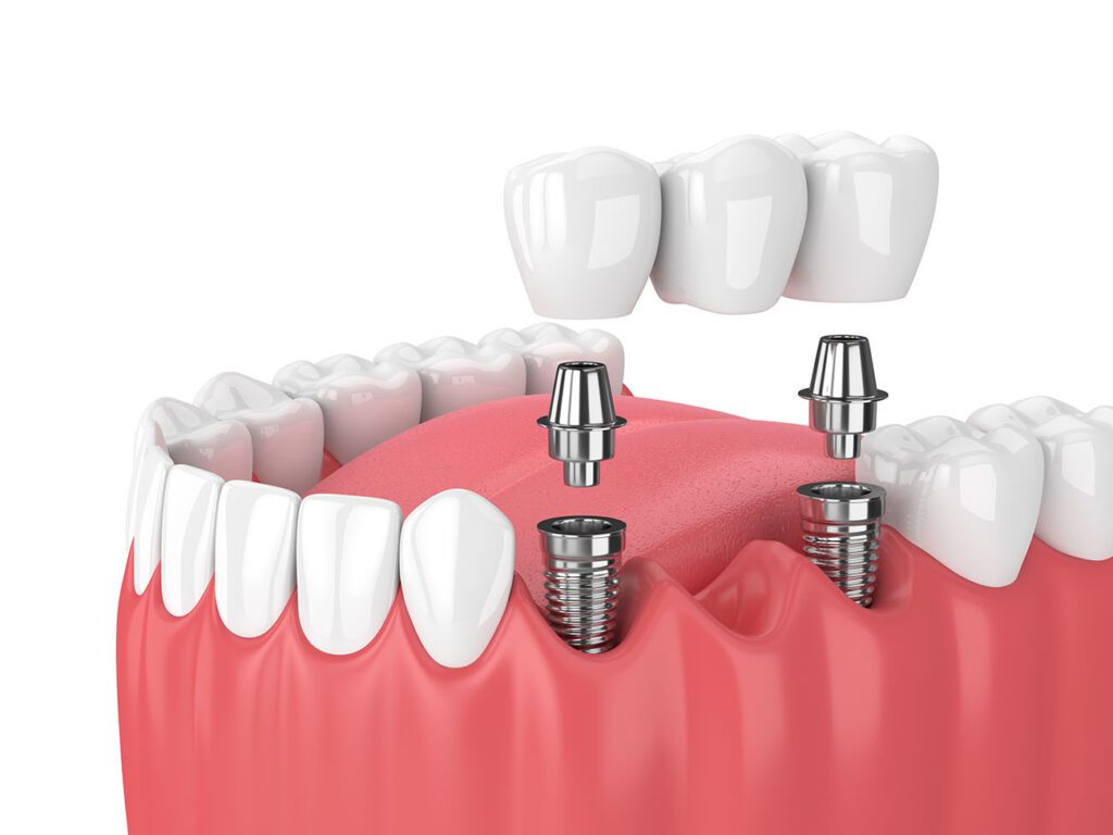 Dentists often recommend dental bridges for patients who have lost one or more teeth for a stable and aesthetically pleasing solution.