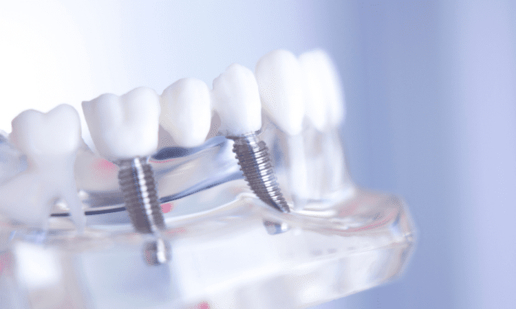 Understanding the available restoration options for dental implants can help you make informed decisions about your dental health.