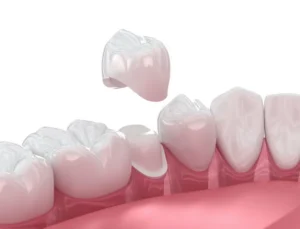 Dental Crowns 101: What They Are in Wayne, PA